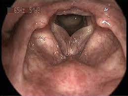 <ul><li><p>swelling of the vocal folds</p></li><li><p>“Smoker’s voice”</p><ul><li><p>related to smoking</p></li></ul></li><li><p>requires surgical intervention (drain the fluid)</p></li></ul>