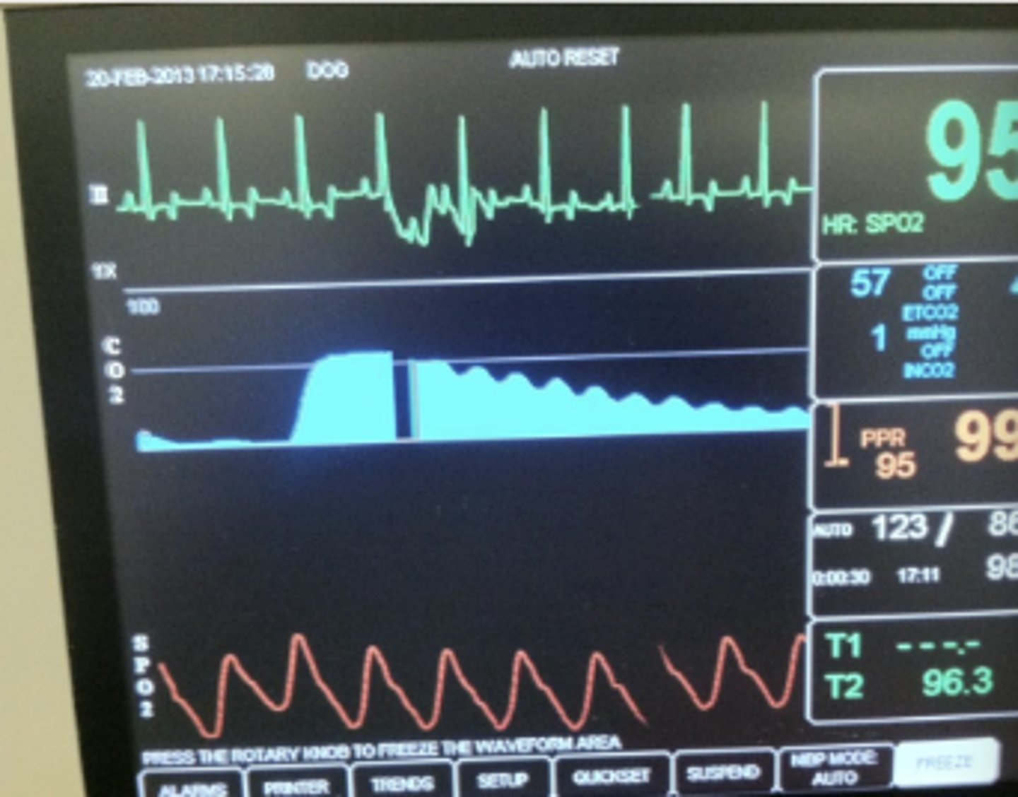 <p>- Look at the pulse waves at the same time and see if they are also abnormal (note that the change in the ECG image is artifact because the pulse wave is normal)</p>