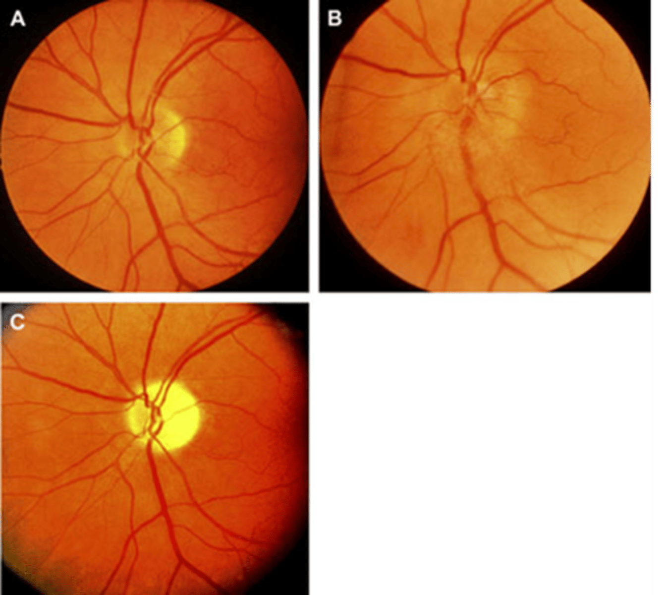 <p>Acutely, a nerve in <strong>GCA</strong> and AAION will appear as swollen +/- hemes (B). How does it appear long term?</p>