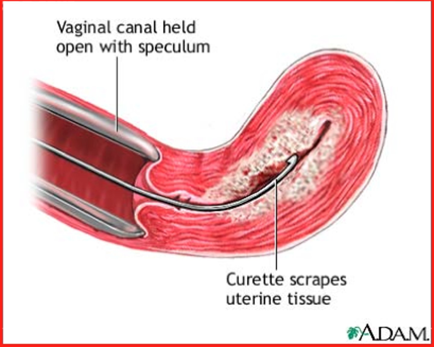 <p>dilatación y curetaje, legrado, raspado</p>