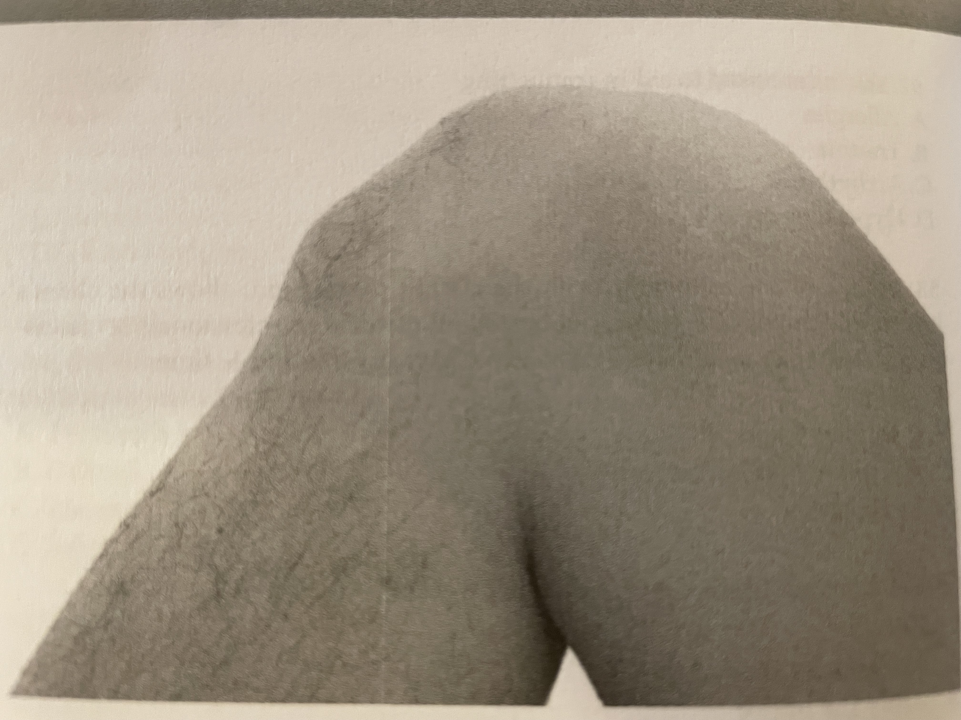 <p>A 30 year old client is positioned supine on a massage table. The massage therapist undrapes the lower limb, and they see the condition pictured. What would be inappropriate treatment modification on behalf of the therapist</p>