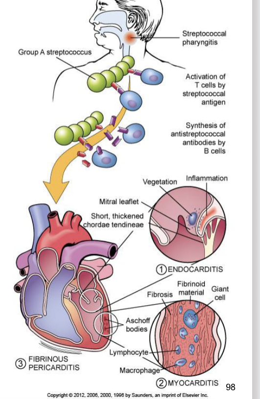 <ul><li><p>occurs 2 weeks after an episode of strep throat</p></li><li><p>affects joints, the skin, and the brain</p></li><li><p>cell mediated immune reaction develops and the suppressor t lymphocytes and macrophages many also damage various tissues</p></li></ul><p></p>