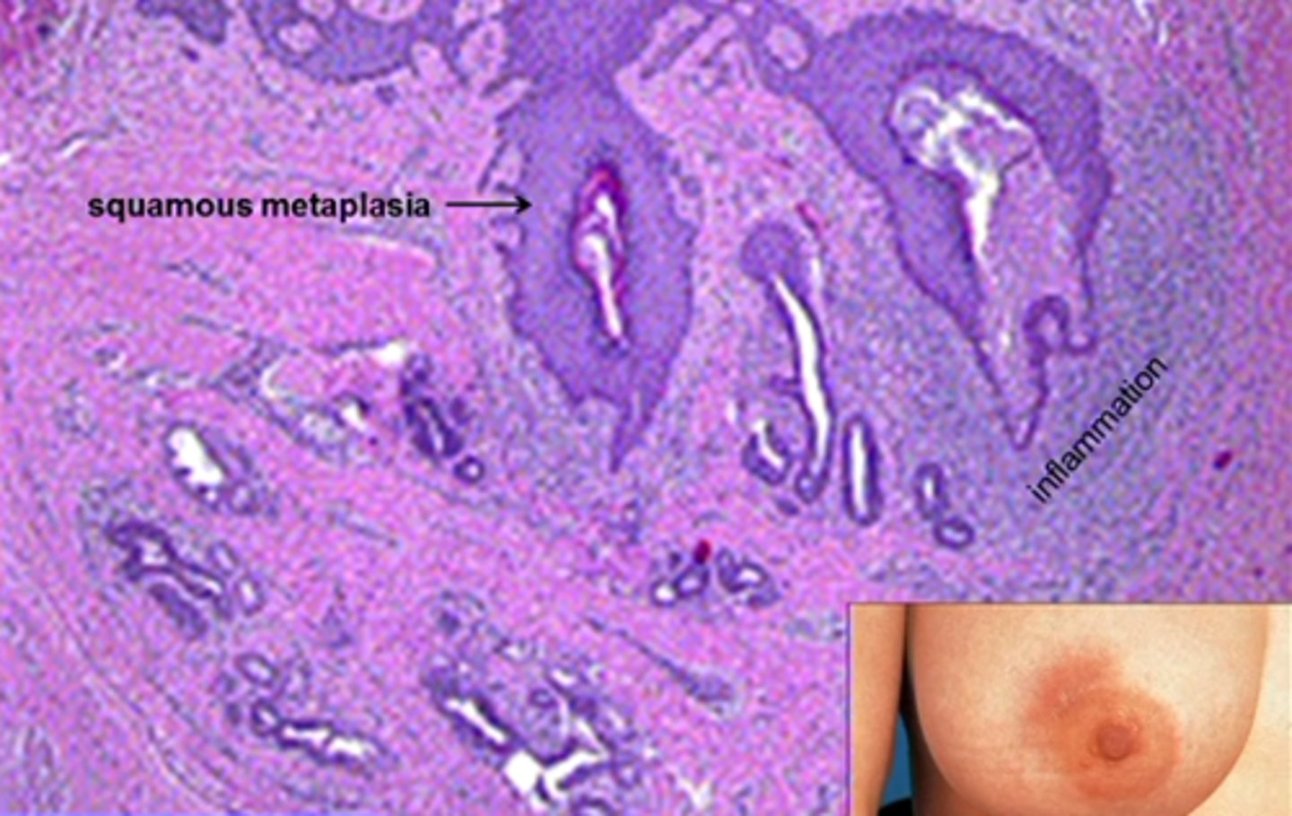 <p>Define Condition:</p><p>Squamous metaplasia of lactiferous ducts inflammation of subareolar ducts</p><p>-Hx/Path: SMOKING (90%)</p><p>&gt; Toxic to ducts</p><p>&gt; Relative Vit A def (needed for differentiation of specialized epithelial surfaces) in ducts --&gt; Squamous metaplasia</p><p>-Dx: Histo = Columnar luminal cells -&gt; squamous metaplasia -&gt; keratin plugs in ducts -&gt; obstruction and inflammation -&gt; peri-areolar mass</p>