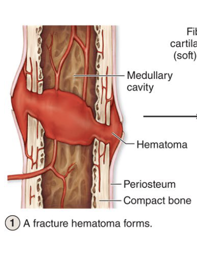 <ul><li><p><strong><u>First step to fracture repair</u></strong></p></li><li><p><strong><u>Clotted blood form at fracture site</u></strong></p></li></ul><p></p>