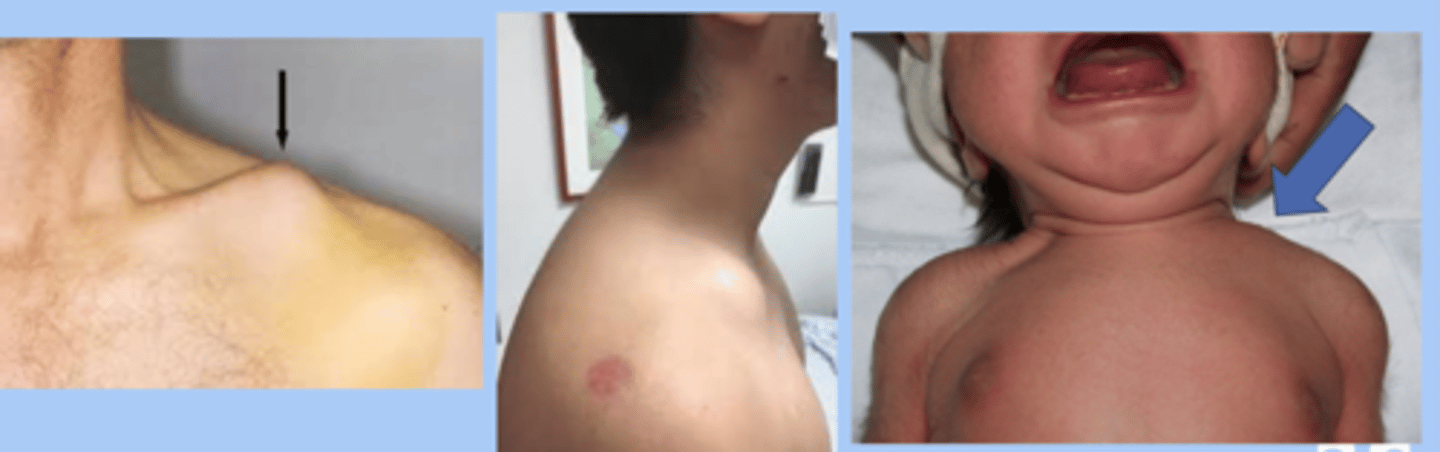 <p>-caused by fall onto shoulder or difficult vaginal birth </p><p>-midshift: pain the middle 1/3, snapping at time of injuru, local swelling, tent of skin, creptitus </p><p>-distal 1/3: confused with AC, pain and tenderness around AC joint, swelling</p><p>-proximal 1/3: least common </p><p>-infants: crepitus, edema, lack of movement, asymmetrical bone contour, crying with passive motion </p><p>-tx: immobilization vs casting </p>