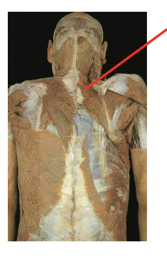 <p>What is this muscle What is its origin. Where does it inserts. </p>