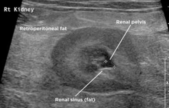 <p>U/S findings are nonspecific:</p><p>-renal pelvic dilation (+/- echogenic fluid - suggestive of pus)</p><p>-dilated ureter</p><p>-blunting of renal papilla</p><p>-hyperechoic retroperitoneal fat around kidney</p>