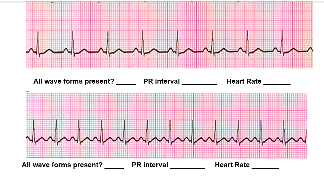 <p>Fill in the blanks for the top EKG strip and the bottom EKG strip.</p>
