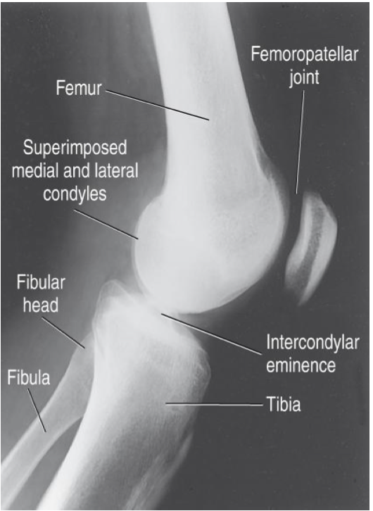 <p><span style="line-height: normal;"><span>• </span></span>Femoral condyles superimposed</p><ul><li><p class="p1"><span style="line-height: normal;"><span>&nbsp;</span></span>Determined by rotation</p></li><li><p class="p1"><span style="line-height: normal;"><span>&nbsp;</span></span>Use abductor tubercle to determine if medial condyle is anterior/posterior</p></li></ul><p class="p1"><span style="line-height: normal;"><span>• </span></span>Distal articular surfaces of femoral condyles superimposed</p><ul><li><p class="p1"><span style="line-height: normal;"><span>&nbsp;</span></span>Determined by adequate CR angle</p></li></ul><p class="p1"><span style="line-height: normal;"><span>• </span></span>Patella in profile (indicates no rotation)</p><p class="p1"><span style="line-height: normal;"><span>• </span></span>Patellofemoral joint space open</p><p class="p1"><span style="line-height: normal;"><span>• </span></span>Fibular head is partially superimposed by tibia</p><p class="p1"><span style="line-height: normal;"><span>• </span></span>Soft tissues well demonstrated</p><p class="p1"><span style="line-height: normal;"><span>• </span></span>Filter used</p>
