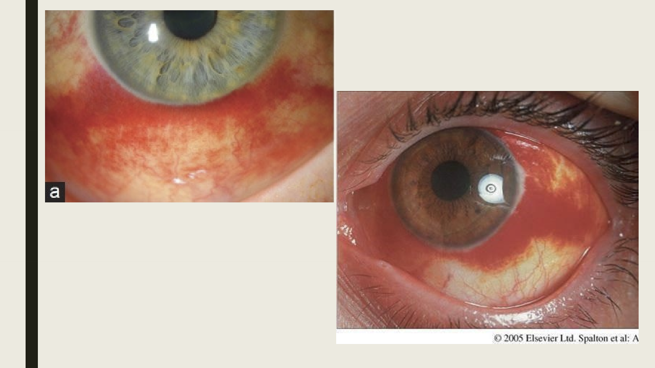 <ul><li><p>Typically no symptoms, hay have irritation if hemorrahge is large</p></li><li><p>Collection of blood beneath of the conj</p></li><li><p>Tends to be sectoral but can be diffuse</p></li><li><p>Details of the sclera will be blocked by the blood&nbsp;</p></li></ul><p></p>
