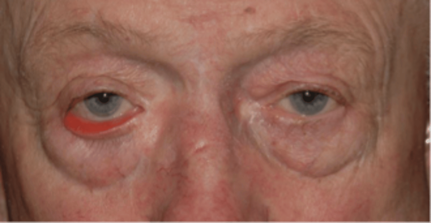 <p>name the eyelid abnormality</p>