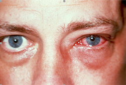 inflammation or infection of the conjunctiva; pink eye