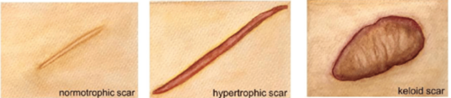 <p>does not go beyond wound border but is raised, red, itchy from excess tension (esp across joints/tendons) = may fade or flatten over time</p>