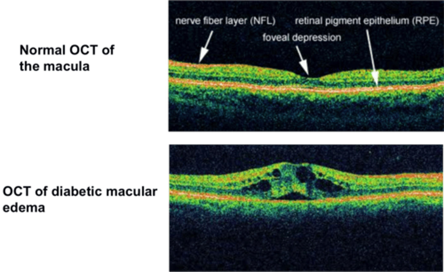 <p>A. Diabetic macular edema</p><p>* Diabetic macular edema (DME) is manifested as retinal thickening caused by the accumulation of intraretinal fluid, primarily in the inner and outer plexiform layers.</p><p>* DME can be present with any level of diabetic retinopathy.</p>