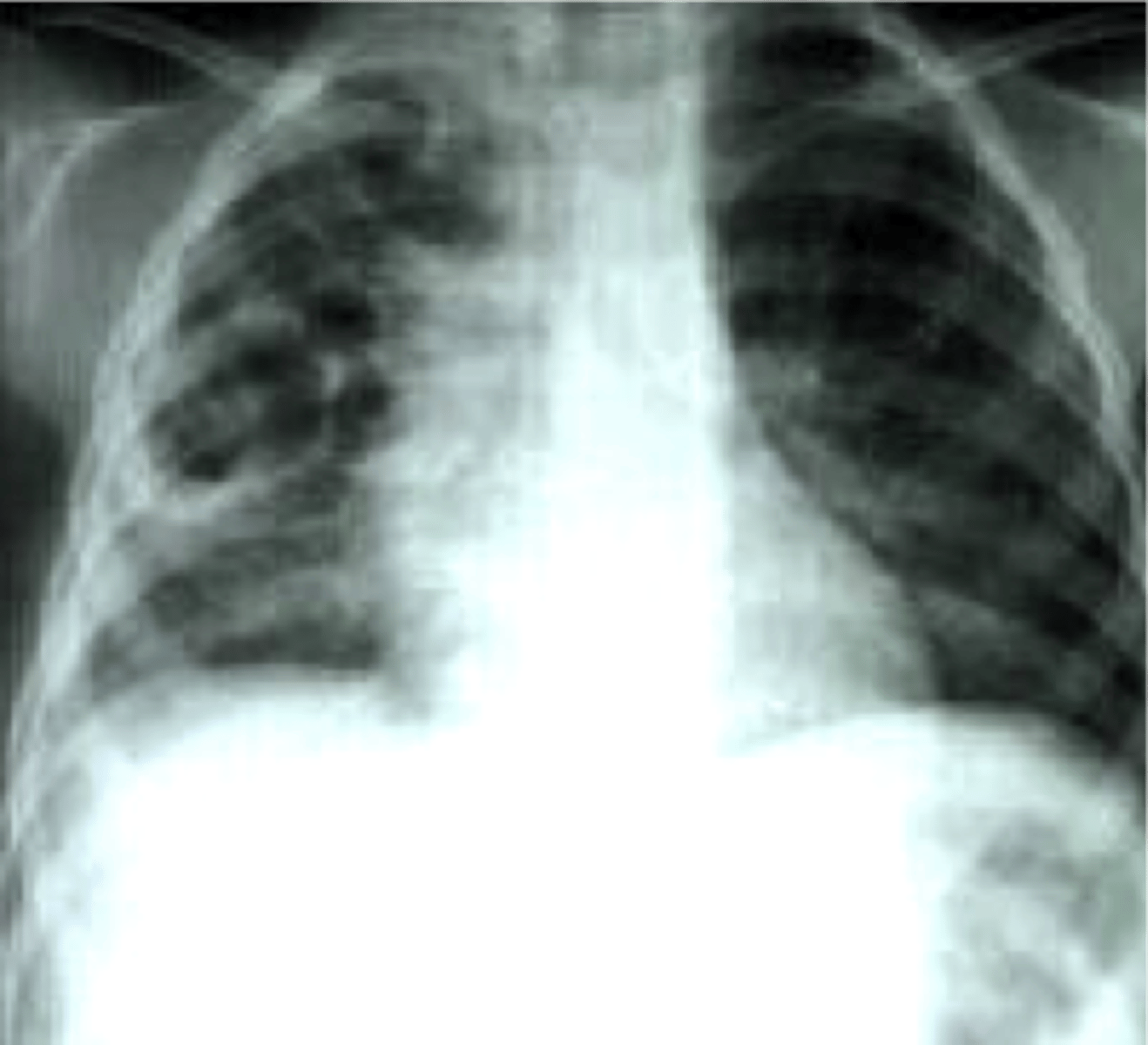 <p>air-filled cysts that may form abcesses; associated with pneumocystis pneumonia</p>