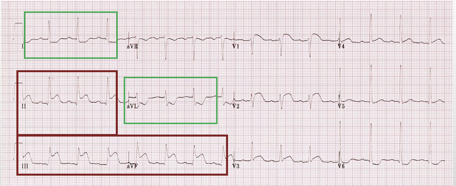 <p>ST elevation in inferior leads (II, III, aVF) w/ reciprocal changes in leads I and aVL</p>