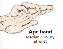 <p>Median nerve injury at wrist </p>