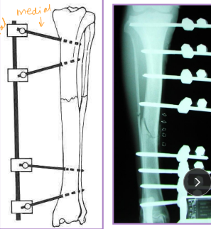 <p>Linear Type 1/A ESF</p>