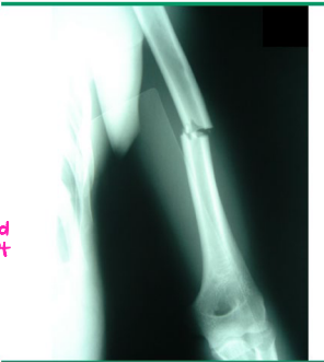 <p><strong>Midshaft Humerus Fractures: Background</strong></p><p>-Epidemiology: </p><ul><li><p>______ in 3rd decade → high velocity trauma</p></li><li><p>________ in 7th decade → low velocity falls</p></li></ul><p>-S/S:</p><ul><li><p>_______ arm pain, swelling, ecchymosis</p></li><li><p>_______ nerve most commonly injured → may see wrist, finger, and thumb extension ___________ and wrist drop</p></li></ul><p>-Diagnosis:</p><ul><li><p>X-ray</p></li></ul><p></p>