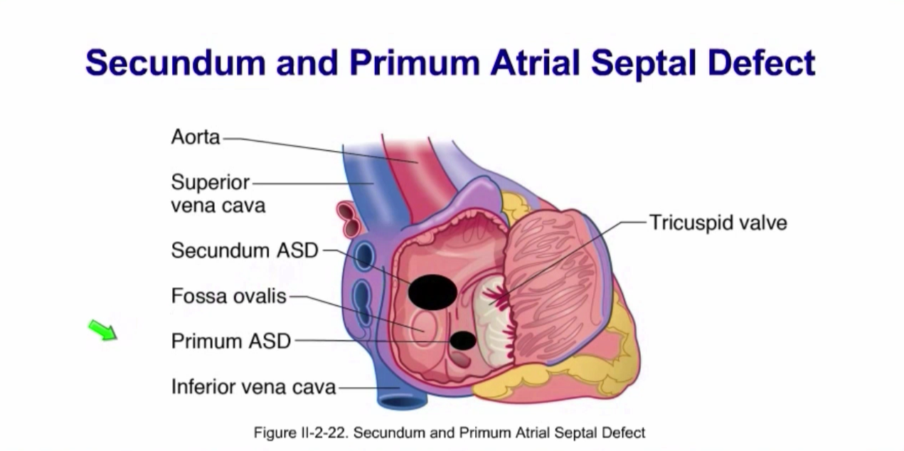 <ol><li><p>Primum ASD (less common, endocardial cushion defect, might be associated with atrioventricular septum defect (membranosus part) and defect of the atrioventriculat valves)</p></li><li><p>Secundum (more common, excessive apoptosis)</p></li></ol><p>If too sever might evolve into Eisenmenger complex (pulmonary hypertension + right to left shunts). The same is with the ventricular septal defect.</p><p></p>