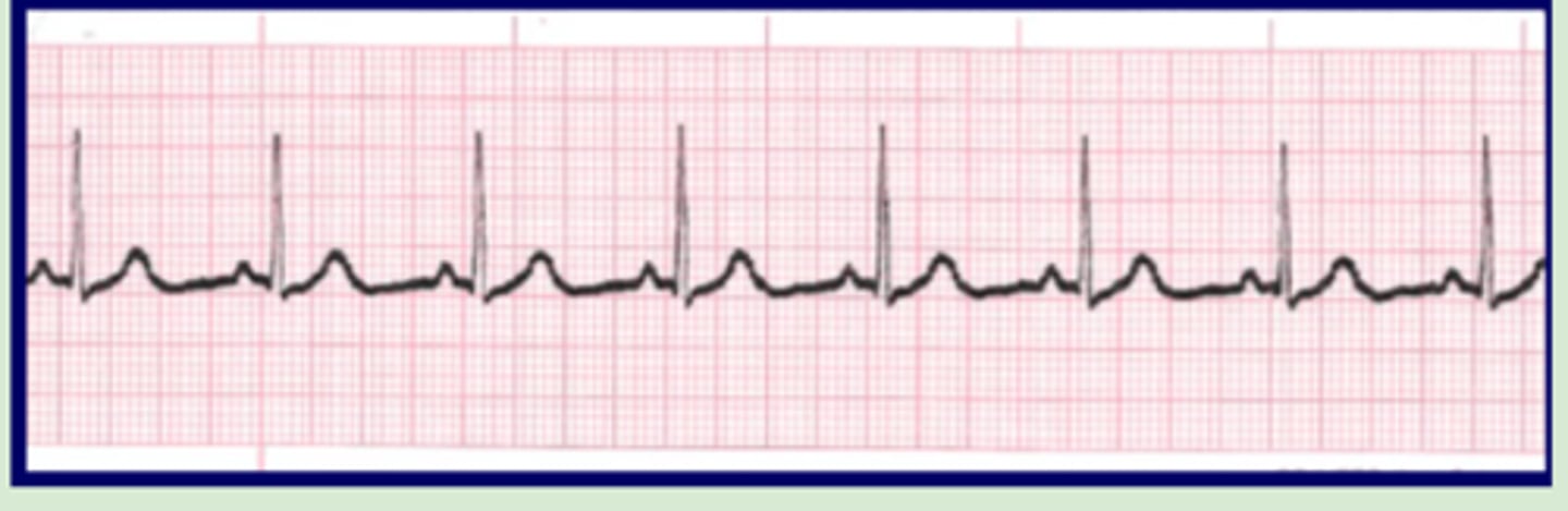 <p>Originate: SA node</p><p>QRS complex: narrow</p><p>P wave: before QRS, same</p><p>Heart rate: 60-100 bpm</p><p>R-R intervals: regular</p>