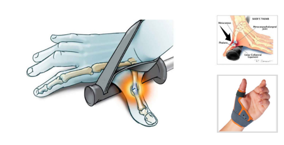 <ul><li><p><strong><mark data-color="blue" style="background-color: blue; color: inherit">rupture of ulnar collateral ligament of MCP joint of thumb</mark></strong></p></li><li><p><strong>CAUSE</strong>: falling with thumb held on pole</p></li><li><p><strong>OT</strong>:</p><ul><li><p>conservative tx for partial tear &gt; thumb orthosis</p></li><li><p>AROM at <strong>2-4wks</strong></p></li><li><p>AAROM and <strong>strengthening at 6-12wks</strong></p></li></ul></li></ul><p></p>