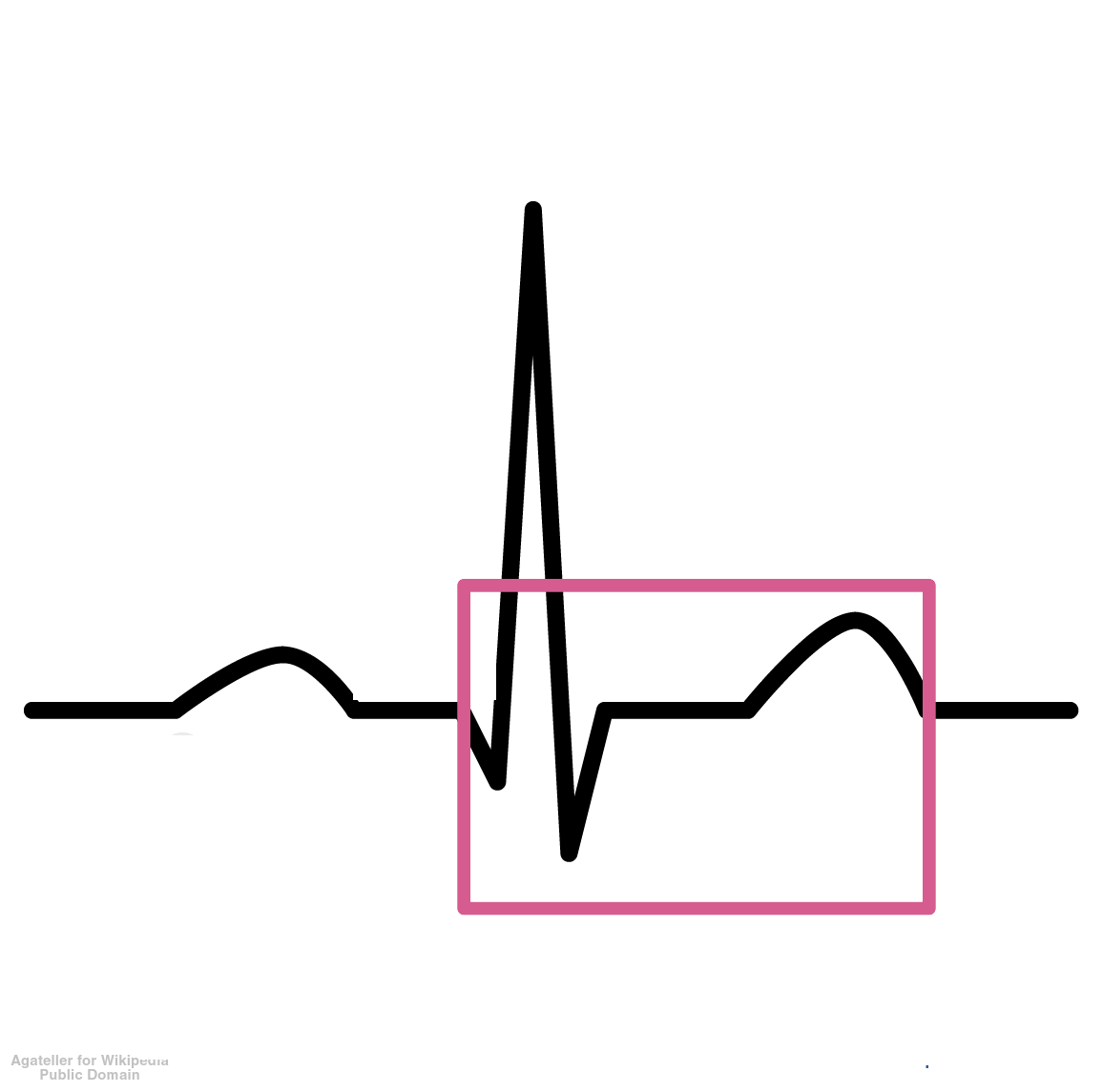 <p>The time from the beginning of the QRS complex to the end of the T wave; represents the total time for ventricular depolarization and repolarization.</p>