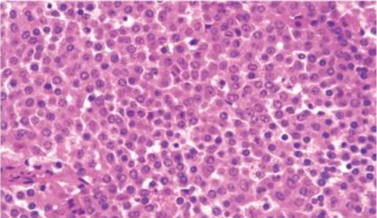 <p>How do Anterior PitNETs appear histologically?</p>