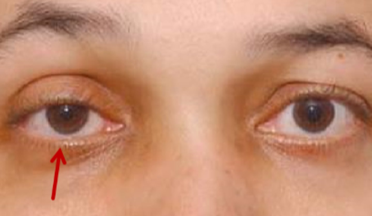 <p>varies with time of day = typically worse later on</p><p>preserves the upper eyelid fold = less severe ptosis</p><p>Kearn's sign / inverse ptosis = due to Mueller's mm of the LL innervated by symp system</p>