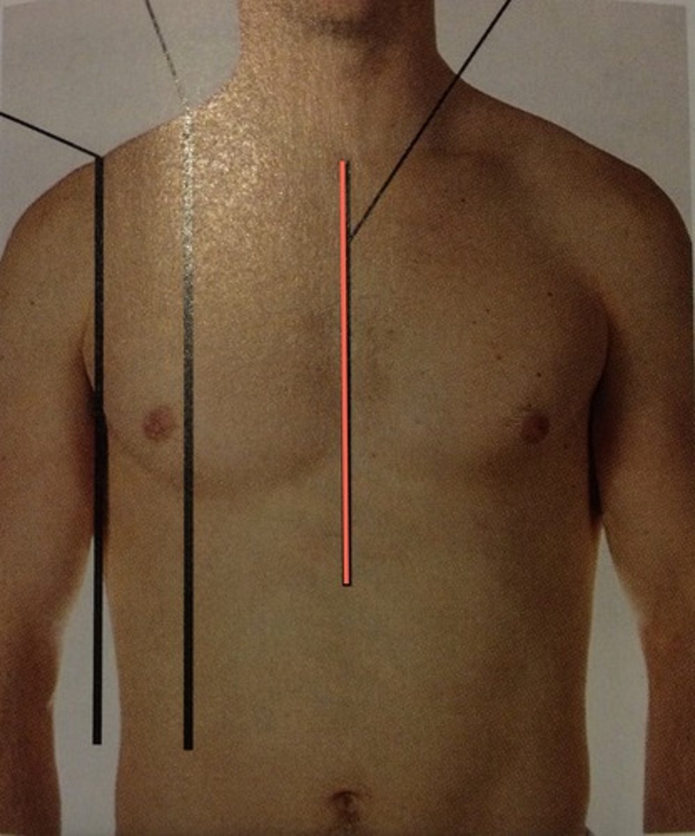 <p>a vertical line down the middle of the sternum</p>