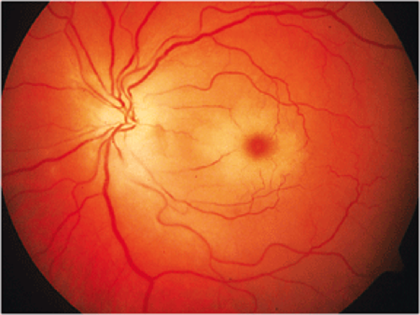 <p>Retinal vascular occlusion</p>