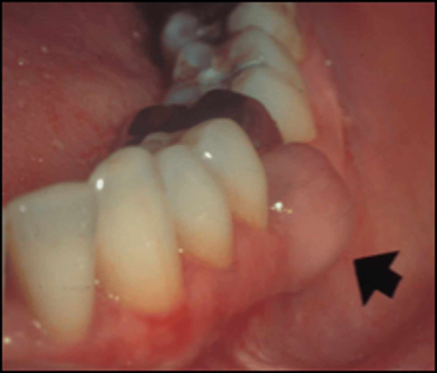 <p>ameloblastoma of gingiva </p><p>• central = lesion in bone, peripheral = lesion in soft tissues</p><p>• RARE presentation of ameloblastoma </p><p>○ most odontogenic cysts/tumors can have peripheral presentations</p><p>• little to no bony involvement</p><p>• not as invasive</p><p>• treatment = surgical excision</p><p>• prognosis = excellent - recurrence is rare</p>