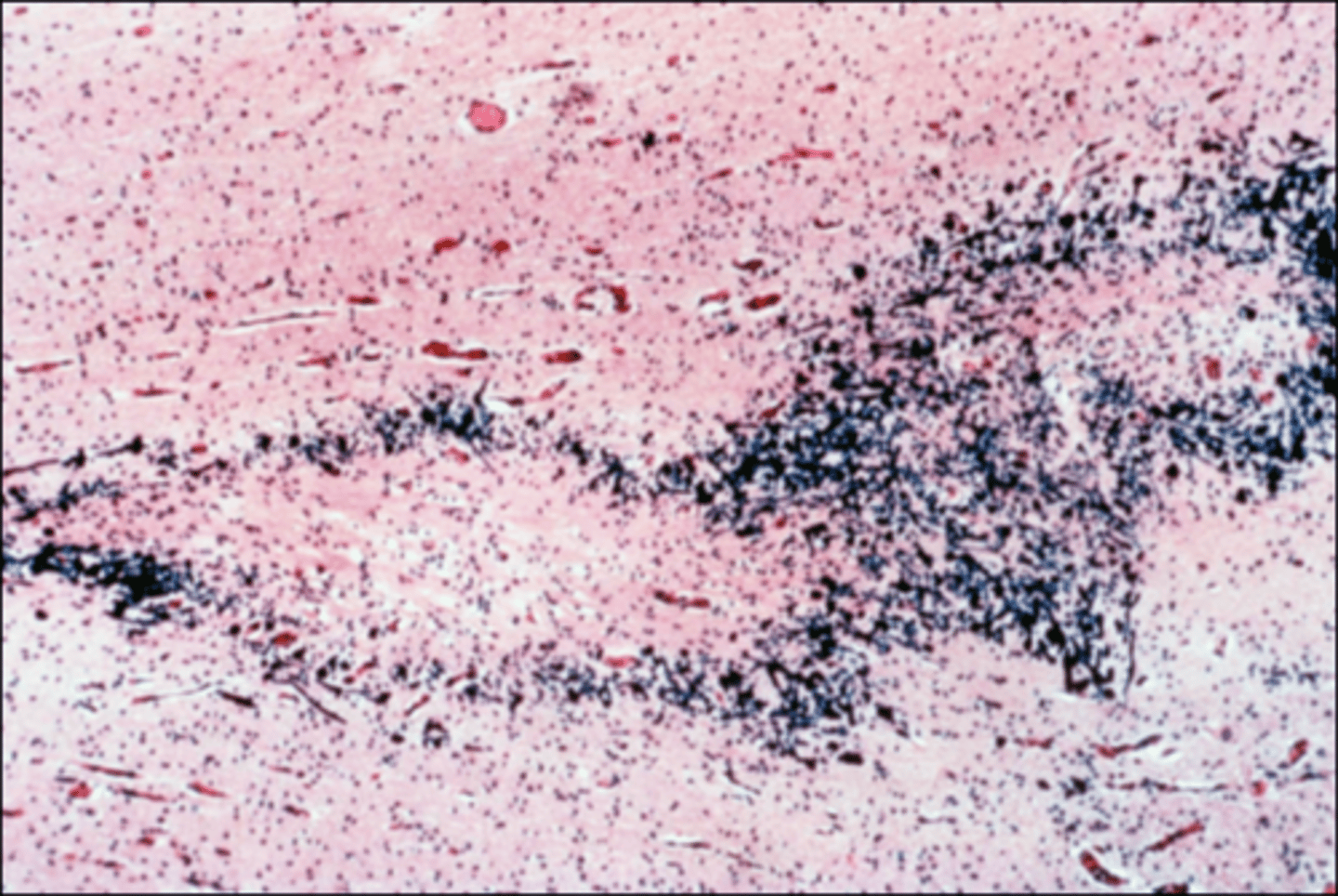 <p>Define Perinatal Brain Injury:</p><p>Ischemic infarcts in brain of premature baby/Yellow plaques of white matter necrosis and calcification of axons</p>