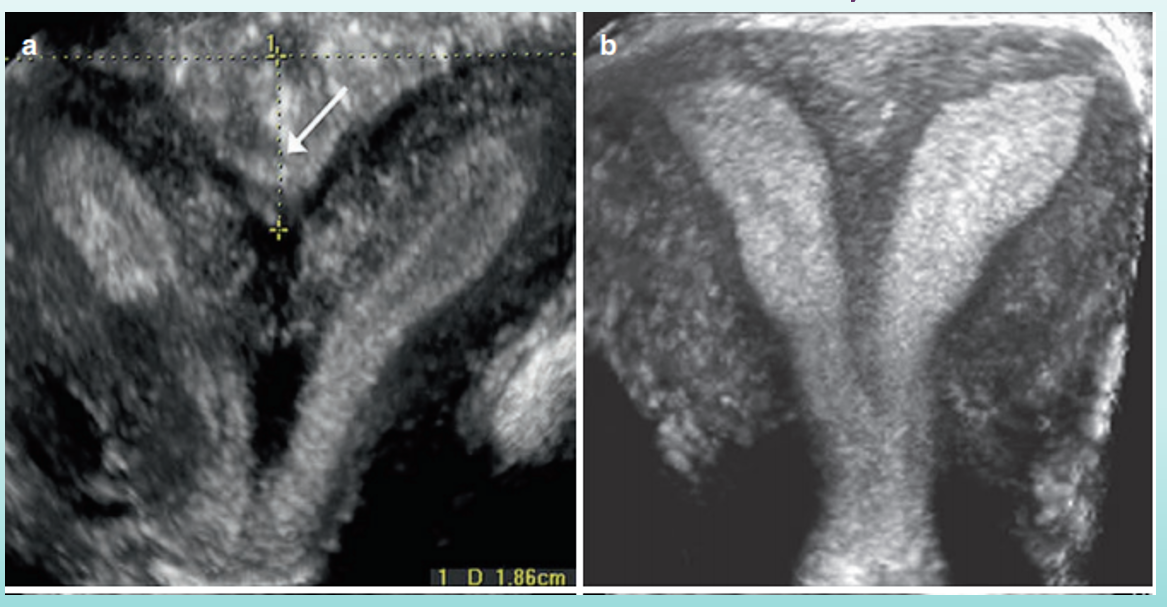 <p>which is bicornuate, which is septate?</p>
