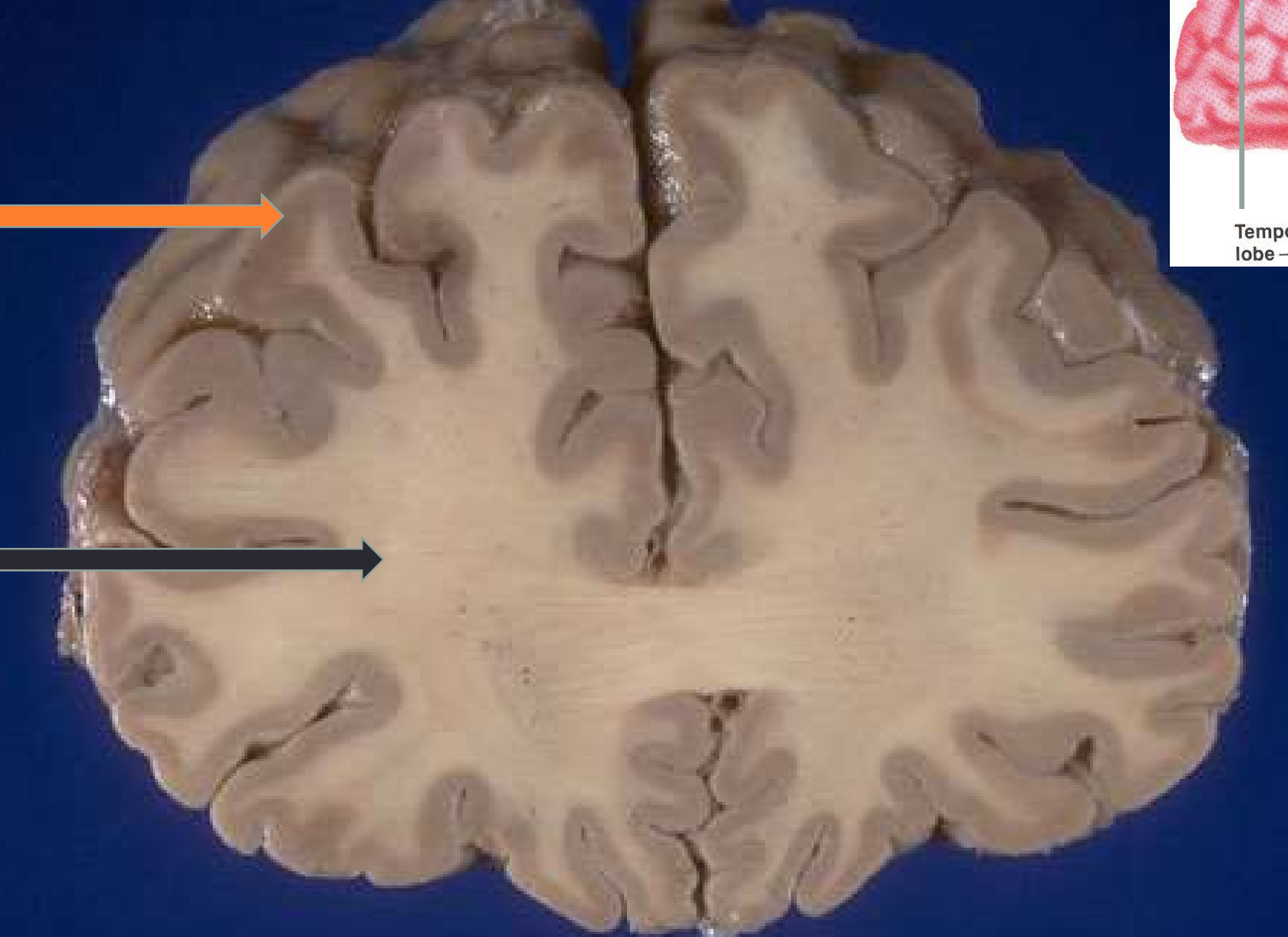<p>Orange = matière grise</p><p>Noir = matière blanche</p>
