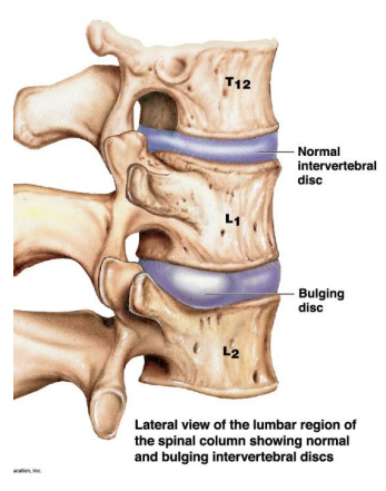 <p>Lateral view of the lumber region of the spinal column showing normal and bulging intervertebral disc</p>