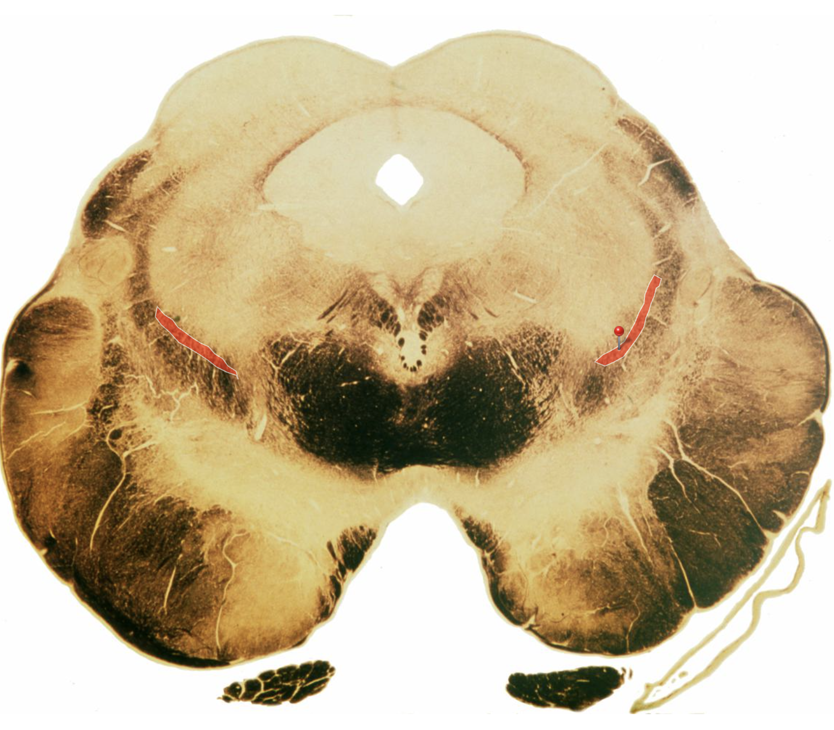 <p>Because it is directly above the Median Lemniscus!</p>