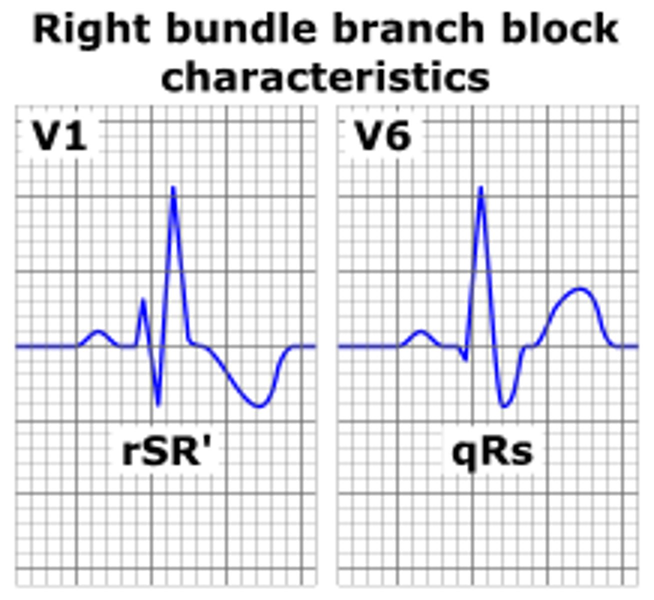 <p>widened QRS (&gt;0.12s)</p><p>double/notched R waves (best to look in V1 and V2)</p>