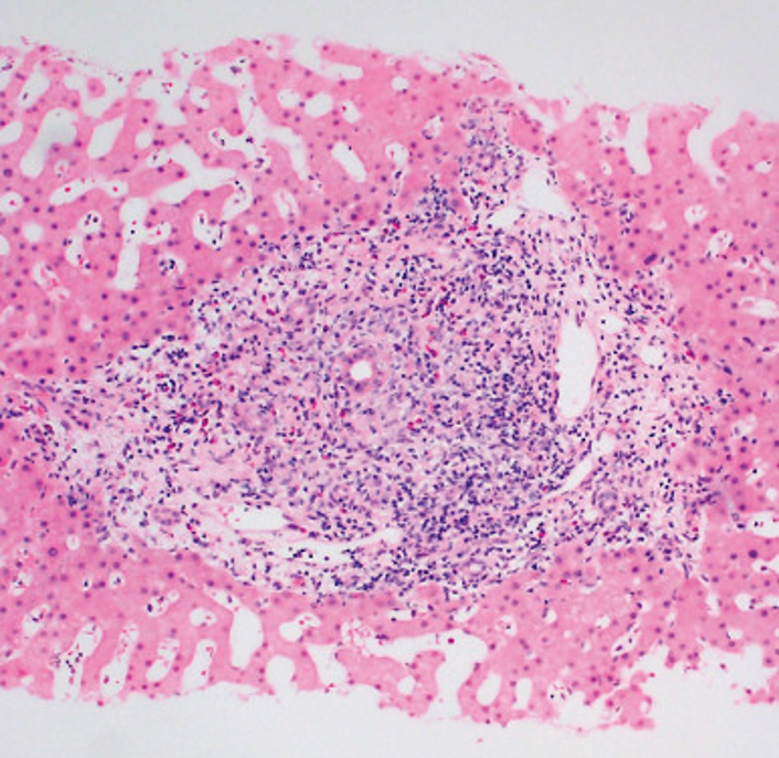 <p>Targets the small and medium sized intrahepatic bile ducts for the mitochondrial antigens; produces AMAutoantibodies</p>