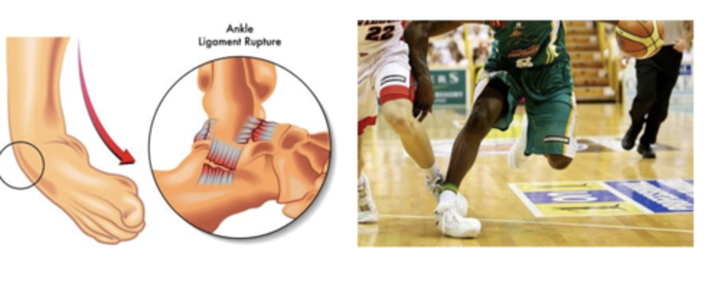 <p>The lateral ankle ligaments (most commonly torn) are severely tensioned as the foot rotates inward</p>