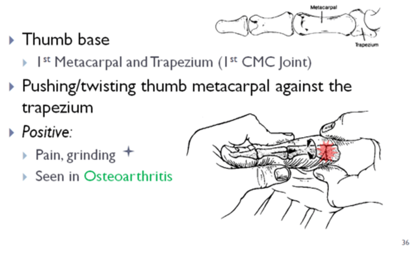 <p>Assesses integrity of the thumb CMC possible joint arthrosis and synovitis; + test reproduction of pain and crepitus at thumb CMC</p>