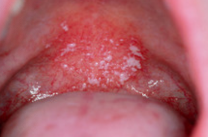 <p>1c.What is the MOST appropriate diagnosis?</p>