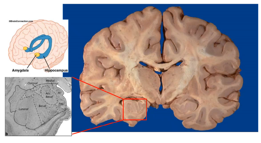 <p>_____ receives preprocessed sensation (tacile, vsual, auditory , visceral) then projects to cerebral cortex and hypothalamus, involved in anger and fear recognition.</p><p></p><p>Position is similar to hypothalamus but is more anterior, hippo campus will have a c shape in coronal view </p>