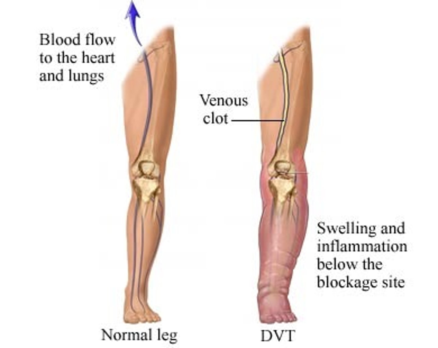<p>A blood clot in a deep vein, most often in legs</p>