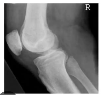 <p>Is this under or over rotated?</p><p>How to correct it?</p>