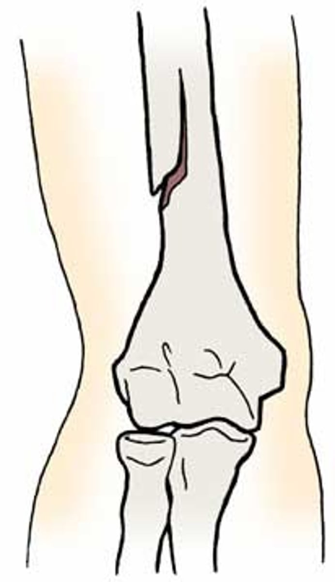 <p>bone is not broken all the way through</p>