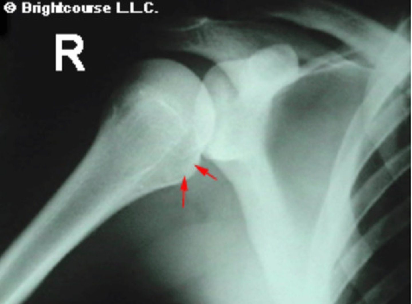 <p>What is being pointed out by the arrows in the image?</p>