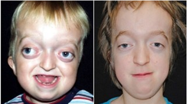 <ol><li><p>wide set proptotic eyes </p></li><li><p>beaked nose </p></li><li><p>underdeveloped jaw </p></li><li><p>dnetal issues - possible cleft lip and palate </p></li><li><p><u>no associated hand and feet anomalies </u></p></li></ol><p></p><p>brachycephaly </p><p></p>