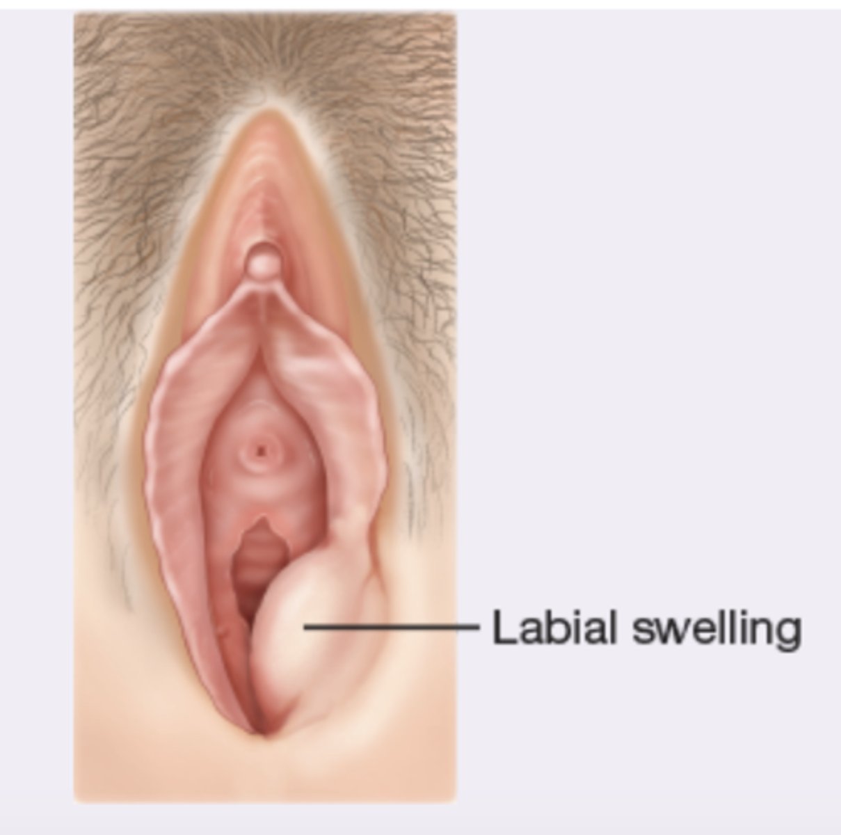 <p>Acute-tense, hot, tender abscess, pus or erythema from or near duct; chronic-nontender cyst large or small</p>