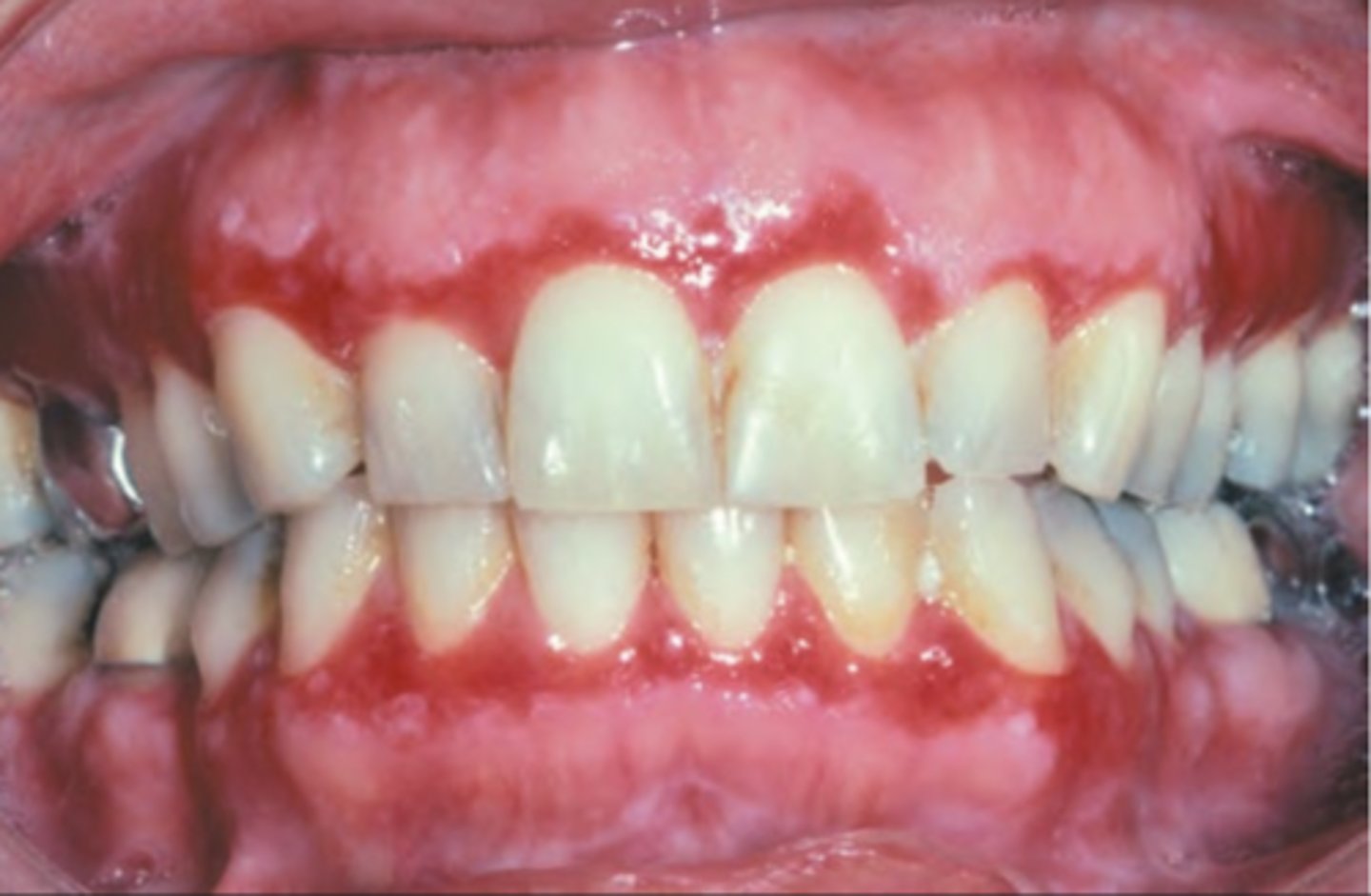 <p>Hint: type of lichen planus</p>